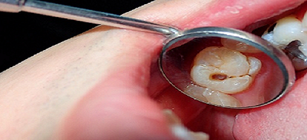 Close up of what a cavity looks like during a dental examination.